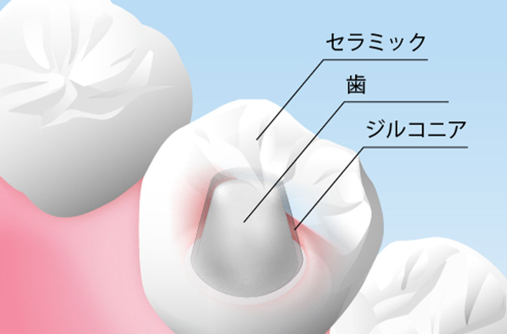 ジルコニアボンド