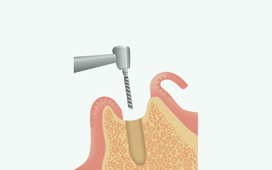一次手術：インプラント体の埋入