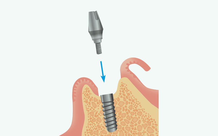 二次手術：アバットメント（土台）の装着
