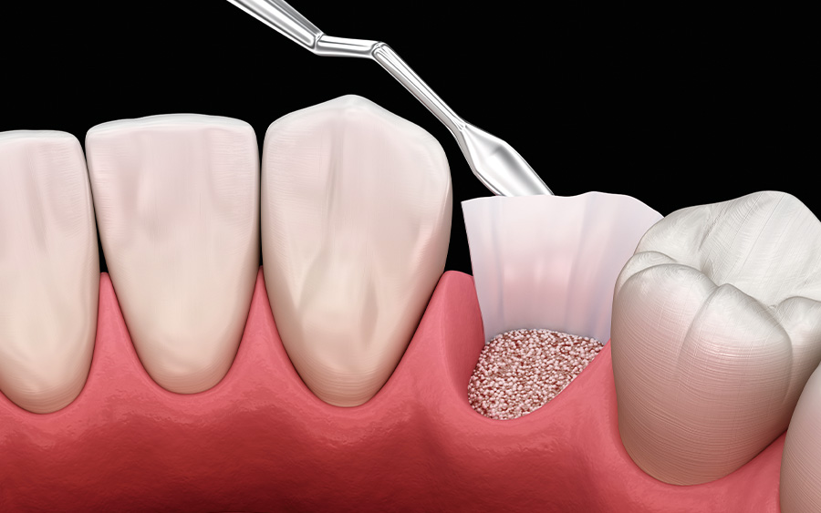 骨造成（症例による）