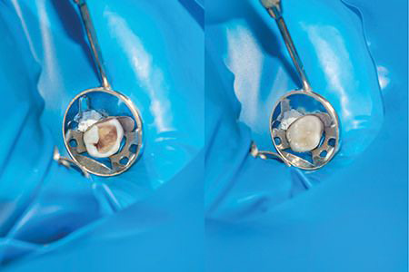 仮歯で蓋をする