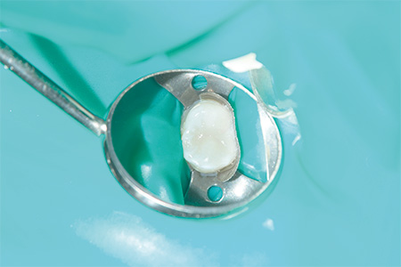 「ラバーダム」で治療部位を清潔に保つ