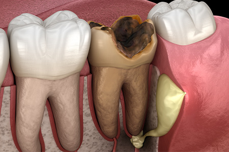 むし歯が神経に達すると