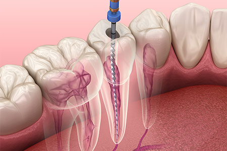 感染した歯髄の除去