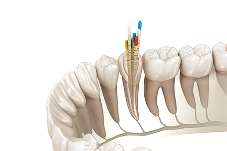 薬剤を詰めて密封する