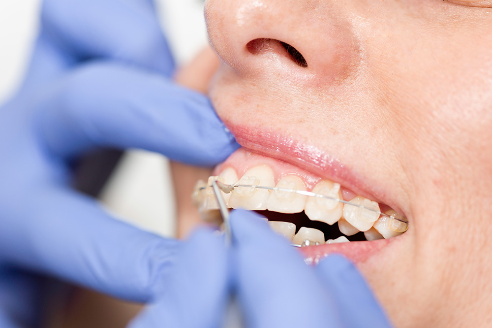 矯正治療のデメリット