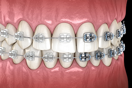 マルチブラケット装置（ワイヤーの矯正）