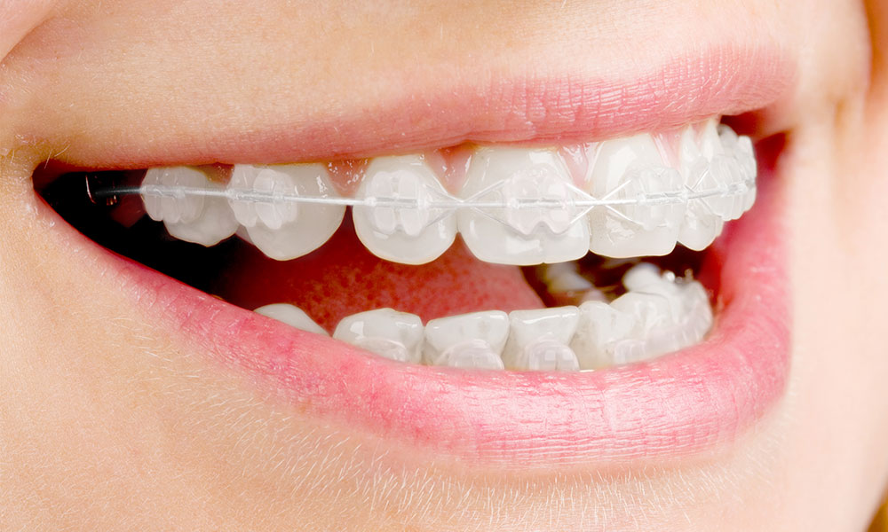 マルチブラケット装置（ホワイトワイヤーの矯正）