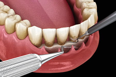 進行した歯周病の治療