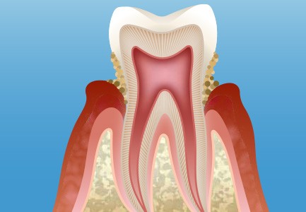 歯周炎（軽度）