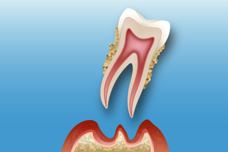 歯周炎（重度）