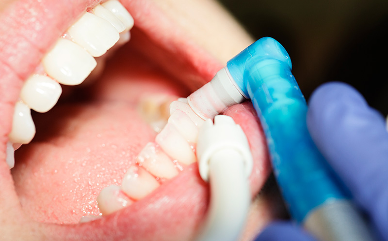 予防・クリーニング