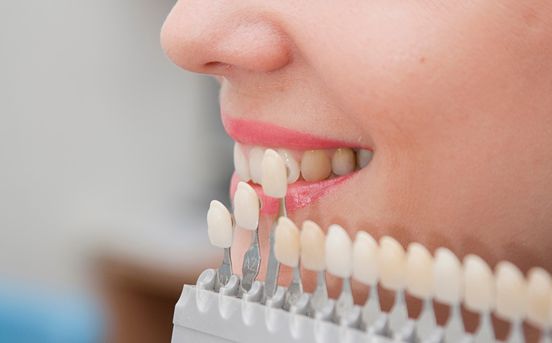 ホワイトニング